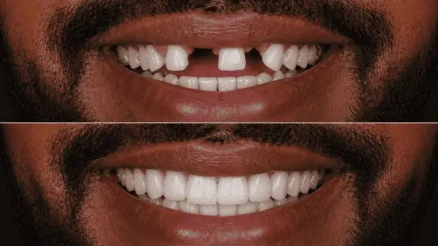 Resultado 1 — antes e depois de prótese protocolo na IOEX