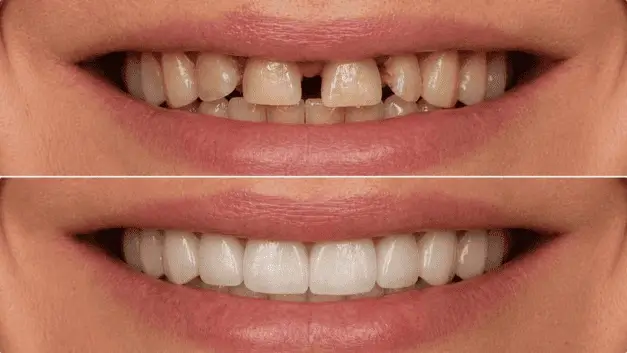Resultado 2 — antes e depois de prótese protocolo na IOEX