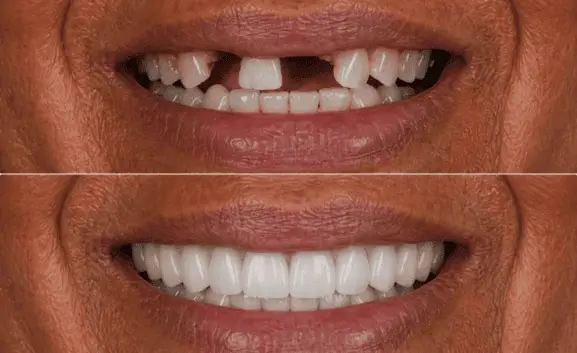 Resultado 3 — antes e depois de prótese protocolo na IOEX