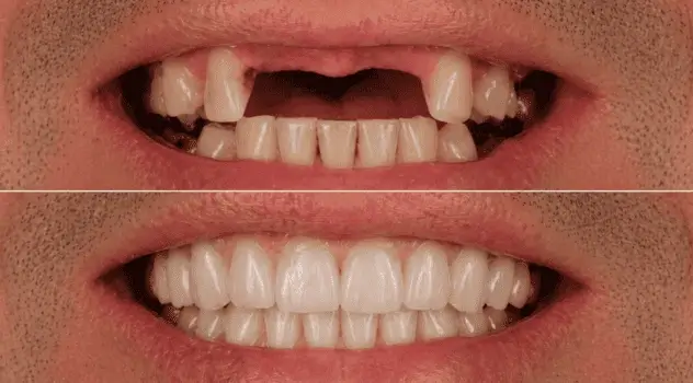 Resultado 5 — antes e depois de prótese protocolo na IOEX