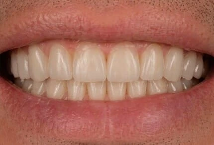 Resultado do tratamento com prótese protocolo com dentes alinhados e naturais IOEX