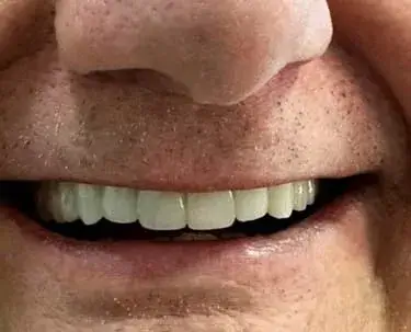 Detalhe do sorriso com prótese protocolo finalizada na clínica IOEX
